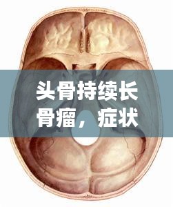 頭骨持續(xù)長骨瘤，癥狀、成因與治療方案深度解析