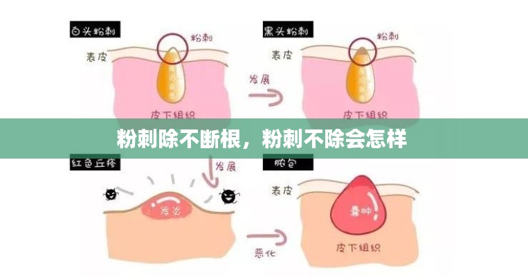 粉刺除不斷根，粉刺不除會怎樣 