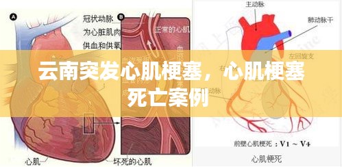 云南突發(fā)心肌梗塞，心肌梗塞死亡案例 