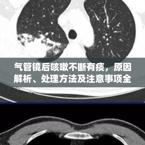 氣管鏡后咳嗽不斷有痰，原因解析、處理方法及注意事項全攻略