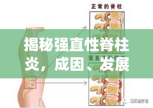 揭秘強直性脊柱炎，成因、發(fā)展與突發(fā)性的真相解析