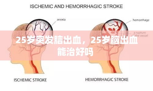 25歲突發(fā)腦出血，25歲腦出血能治好嗎 