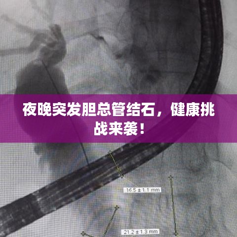 夜晚突發(fā)膽總管結(jié)石，健康挑戰(zhàn)來襲！
